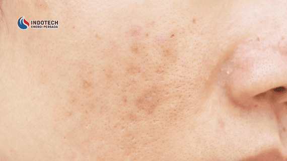 Pengertian Flek Hitam dan Penyebabnya